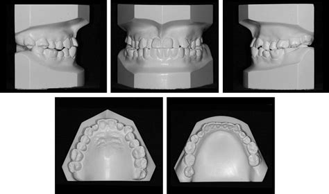 Image result for Crossbite Treatment Options