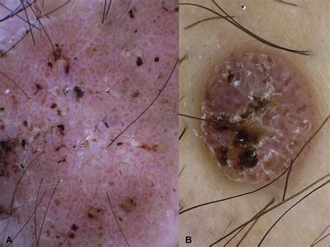 Accuracy of dermoscopic criteria for the differential diagnosis between irritated seborrheic ...