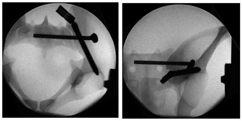 Lumbopelvic Stabilization with Two Methods of Triangular Osteosynthesis ...