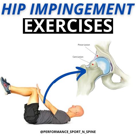 Hip Impingement Syndrome Exercises