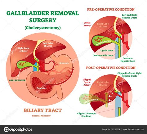 Cholecystectomy - Gallbladder removal surgery, anatomical vector ...