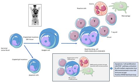 NFkB Pathway and Hodgkin Lymphoma