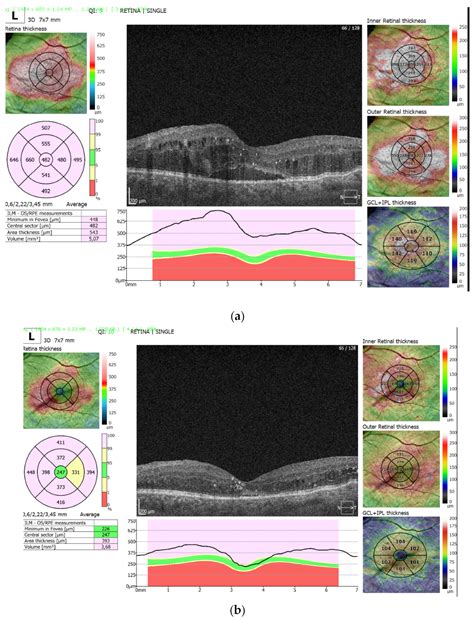 Combined Treatment of Persistent Diabetic Macular Edema with ...