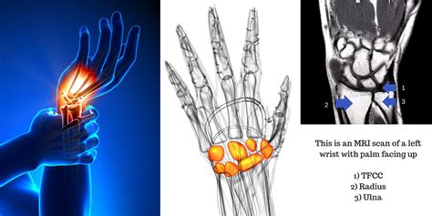 Ulna Bone Wrist Wrist Joint Replacement (Arthroplasty) Orthopedic