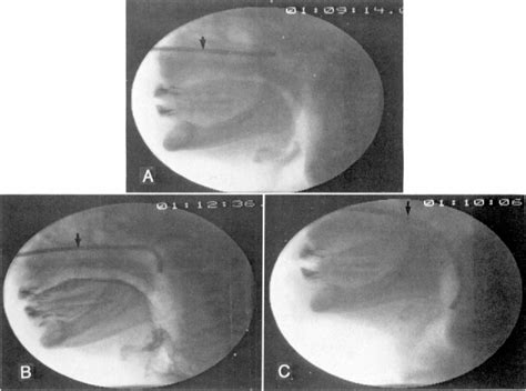 Image result for Modified Barium Swallow Study Basic