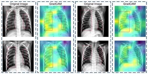 A Deep Convolutional Neural Network for Pneumonia Detection in X-ray ...