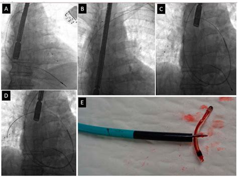Lead Break during Extraction: Predisposing Factors and Impact on ...