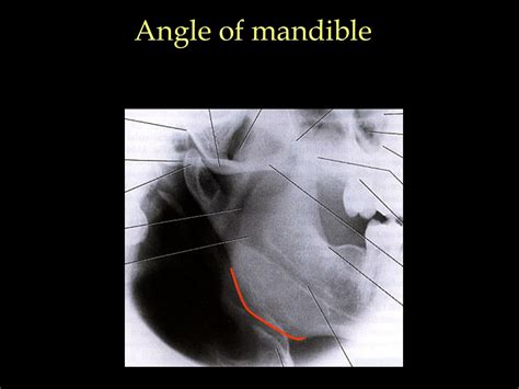 Angle Of Mandible