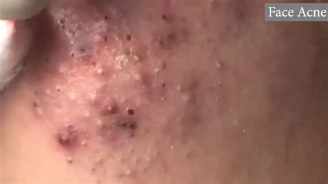 Image result for Largest Infected Exploding Cyst Carbuncle Blackhead