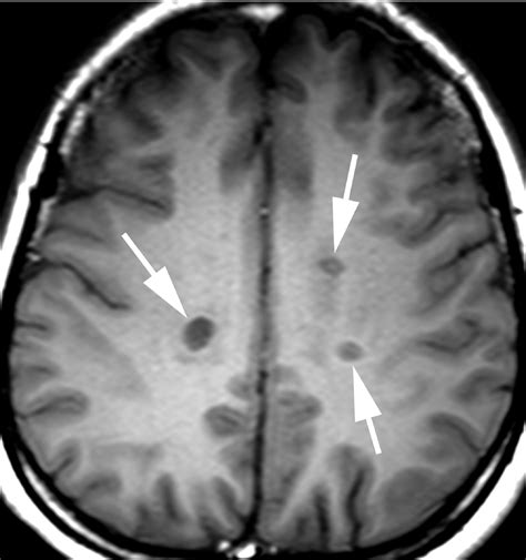 Ms Brain Mri With Contrast