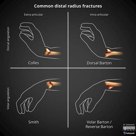 Names Of Wrist Fractures at Hilda Connor blog