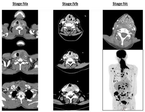 Anaplastic Thyroid Carcinoma: An Update