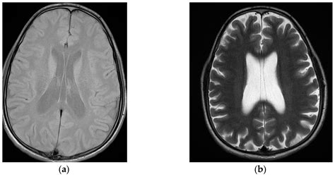 Schizophrenia Misdiagnosis after Capgras and Cotard Delusions in a ...