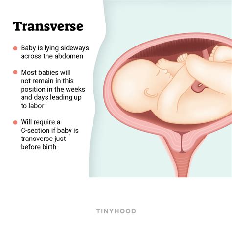 Transverse Face Down Baby