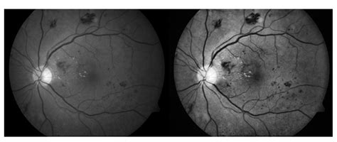 Hemorrhage Detection Based on 3D CNN Deep Learning Framework and ...