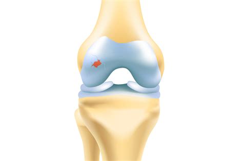 Articular Cartilage Injury | Cartilage conditions