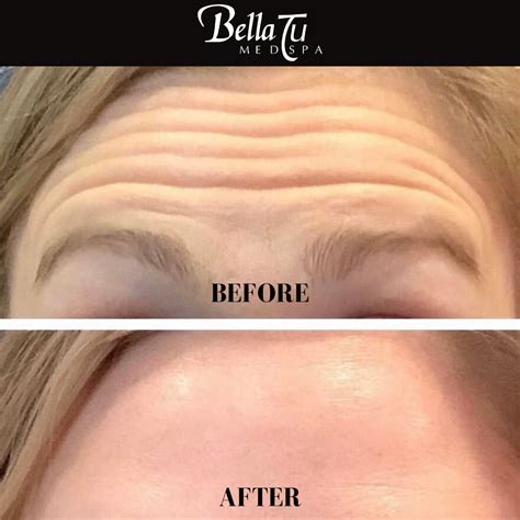 Dermal Fillers Forehead 的图像结果