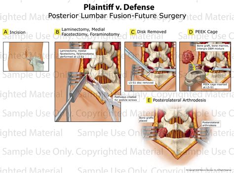 Posterior Lumbar Fusion L5-S1 - MotionLit
