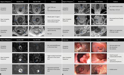 Watch-and-Wait Approach to Rectal Cancer: The Role of Imaging | Radiology