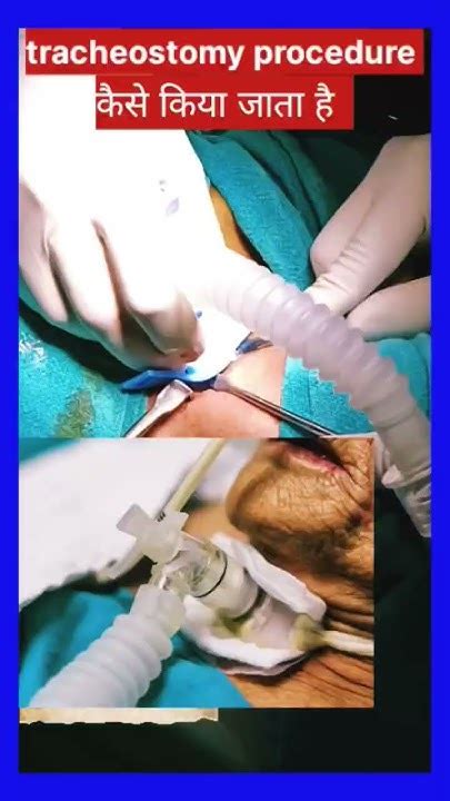 Image result for Trach Procedure