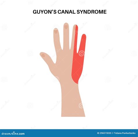 Guyons Canal Syndrome Vector Illustration | CartoonDealer.com #296965368