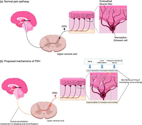 Epicranial headache part 1: Primary stabbing headache - Soonwook Kwon ...