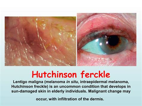Ophthalmology Eponyms II ! | PPT