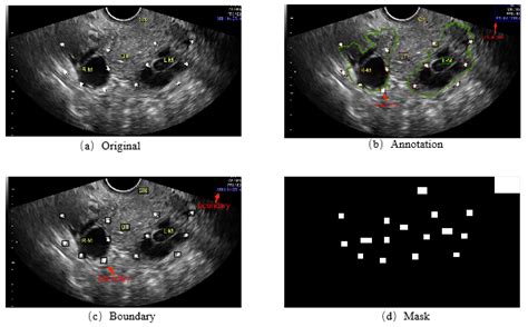Ovarian Cancer Ultrasound