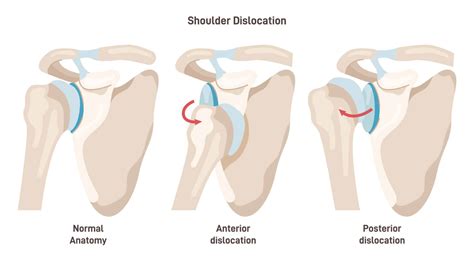 Dislocation – Symptoms, Treatments, Recovery and more…