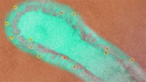 What is human metapneumovirus? Doctors explain HMPV symptoms | LiveNOW ...