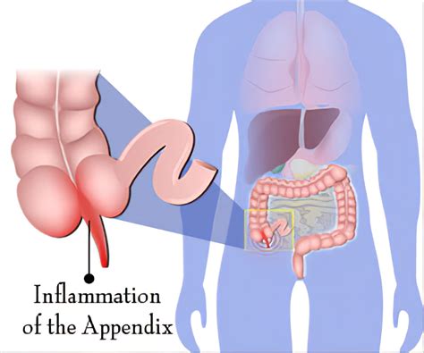Image result for Appendicitis