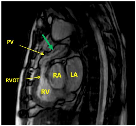 The Ross Procedure: Imaging, Outcomes and Future Directions in Aortic ...