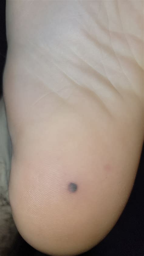 Newly formed black lump on the bottom of my foot? : r/medical_advice