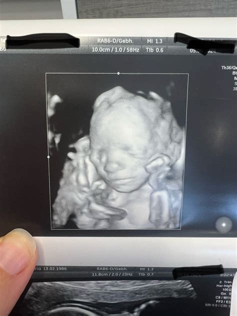 Anatomy Scan/20+ weeks images | BabyCenter