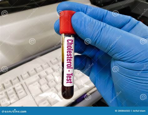 Blood Sample Tube for Cholesterol Test. Stock Photo - Image of ...