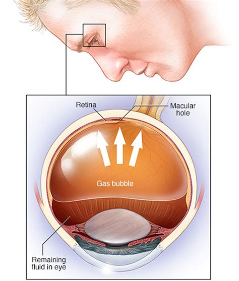 Retinal Detachment - Causes, Signs, Symptoms, Surgery, Repair