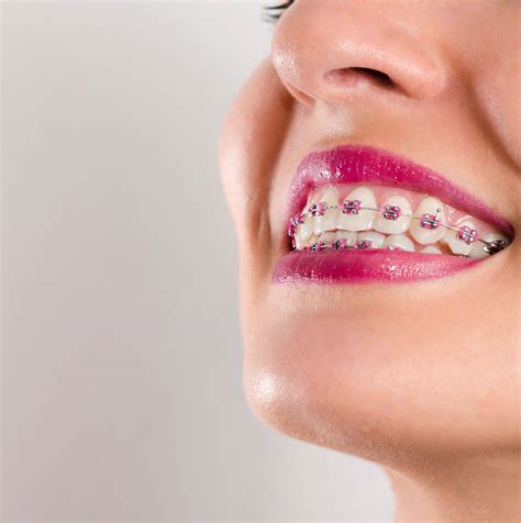 Image result for braces