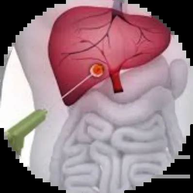 Top Heart Ablation Procedure in India | Healic Cardiology