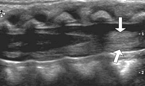 Conus Medullaris Ultrasound