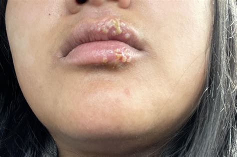 Impetigo On Lips
