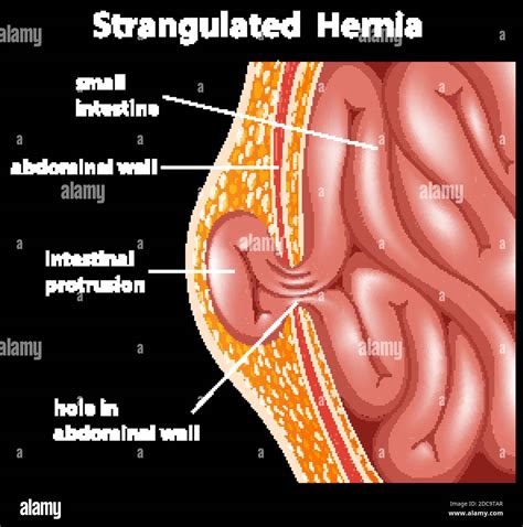 Strangulated Hernia Symptoms