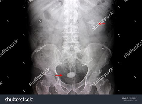 Kidney Stones Kub Xray