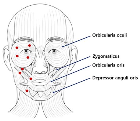 Clinical Application of Botulinum Toxin for Hemifacial Spasm