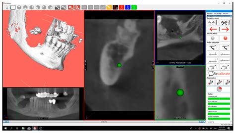 MRONJ Treatment with Ultrasonic Navigation: A Case Report
