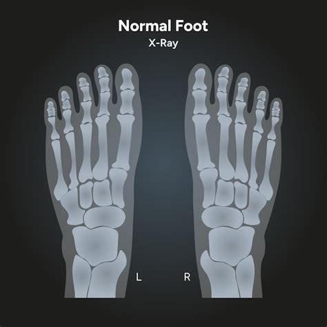 Normal Foot 的图像结果