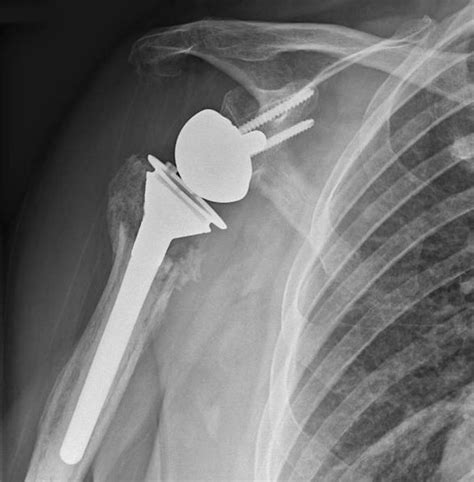 Proximal Humerus Fracture