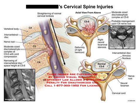 AMICUS Illustration of amicus,injury,cervical,spine,vertebral,body ...
