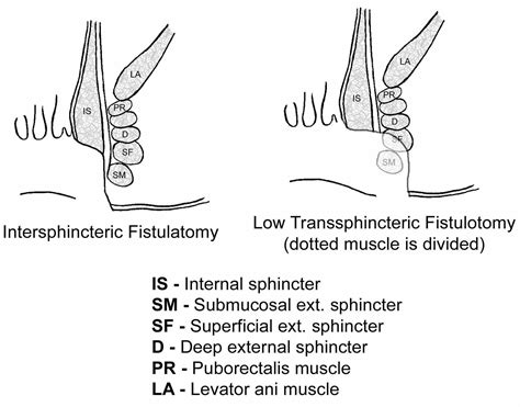 Perianal fistula causes, symptoms, diagnosis, treatment & surgery