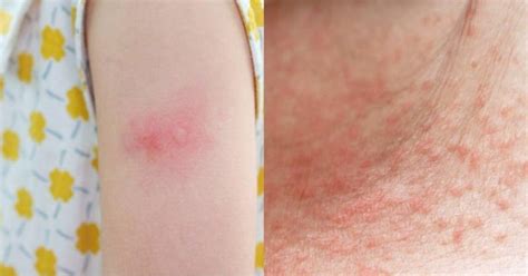 Summer Rashes: उन्हाळ्यात घामामुळे पुरळ येत असेल तर 'या' 5 टिप्स पडतील ...