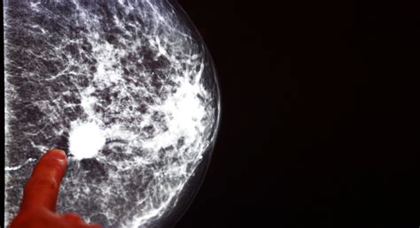 AI analyses mammograms for early stage breast cancer detection